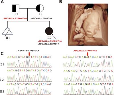 A novel variant c.7104 + 6T > A of ABCA12 linked to autosomal recessive congenital ichthyosis verified by minigene splicing assay